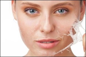 Kemisk peeling