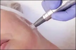Dermatude microneedling