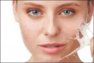 Kemisk peeling