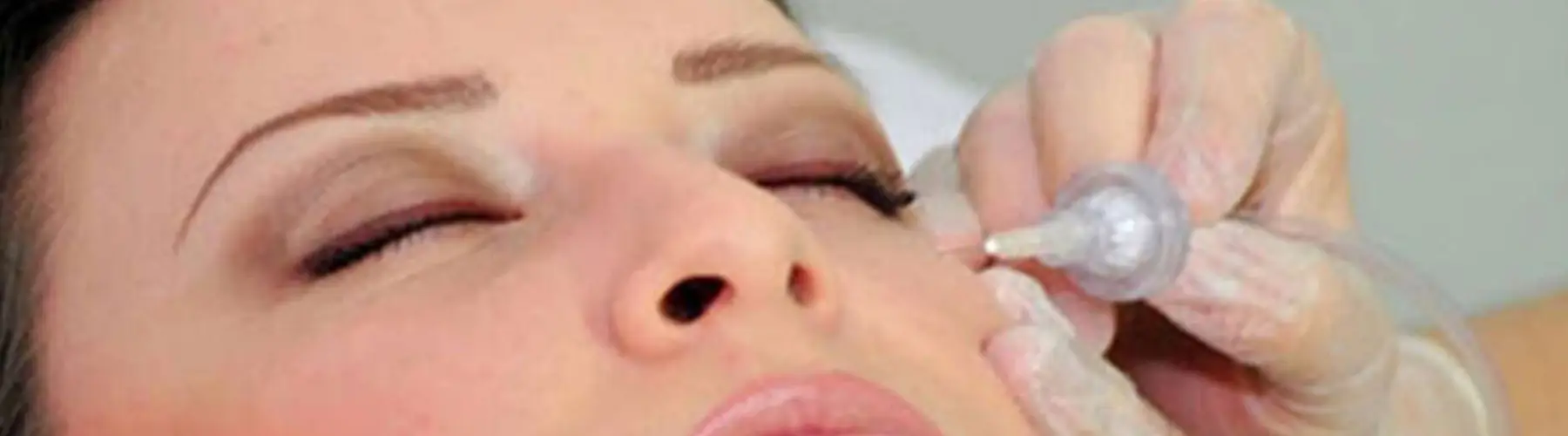 Carboxyterapi kuldioxid behandling Carboxyterapi kuldioxid behandling